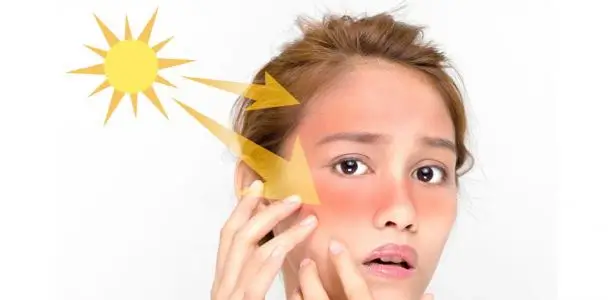 حروق الشمس – تعرف على أعراضها وعلاجات منزلية لتلك الحروق