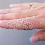 التخلص من جفاف اليدين